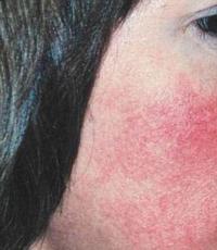 Когда легкий румянец превратился в пылающий изъян: причины красных пятен на лице у женщин Коричневые пигментные пятна на лице